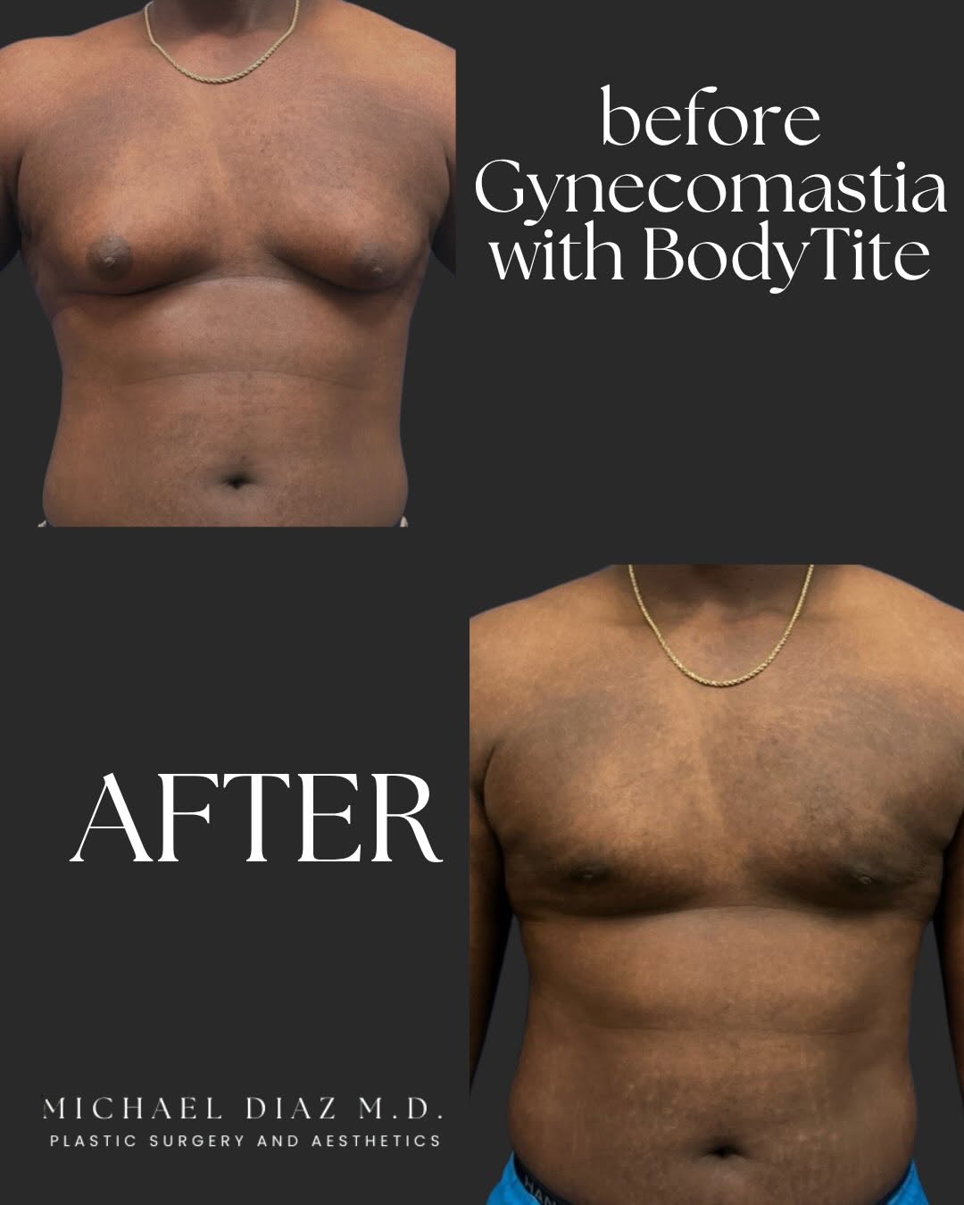 Instagram post by Dr. Michael Diaz: ⭐️Scarless Gynecomastia Surgery!⭐️ . ❔Are you looking for a minimally invasive excision of unwanted glandular and fatty tissue of the chest?…