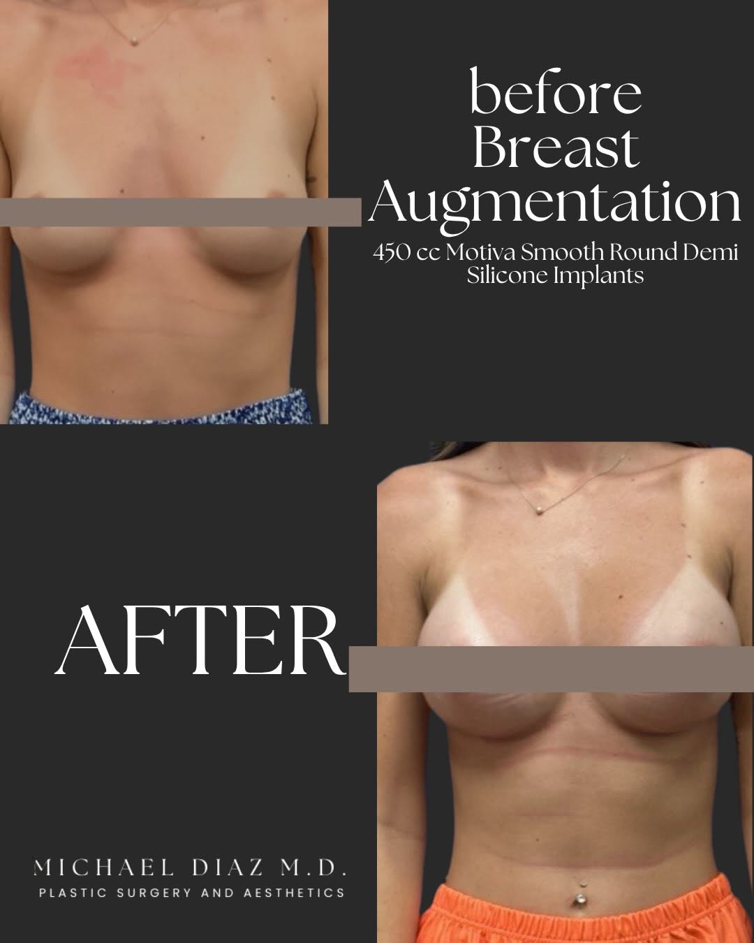 Instagram post by Dr. Michael Diaz: 👙 Wanting a fuller look in bathing suits & dresses? 🗓️ Schedule a consult with us before September and take advantage of our $250 OFF surg…