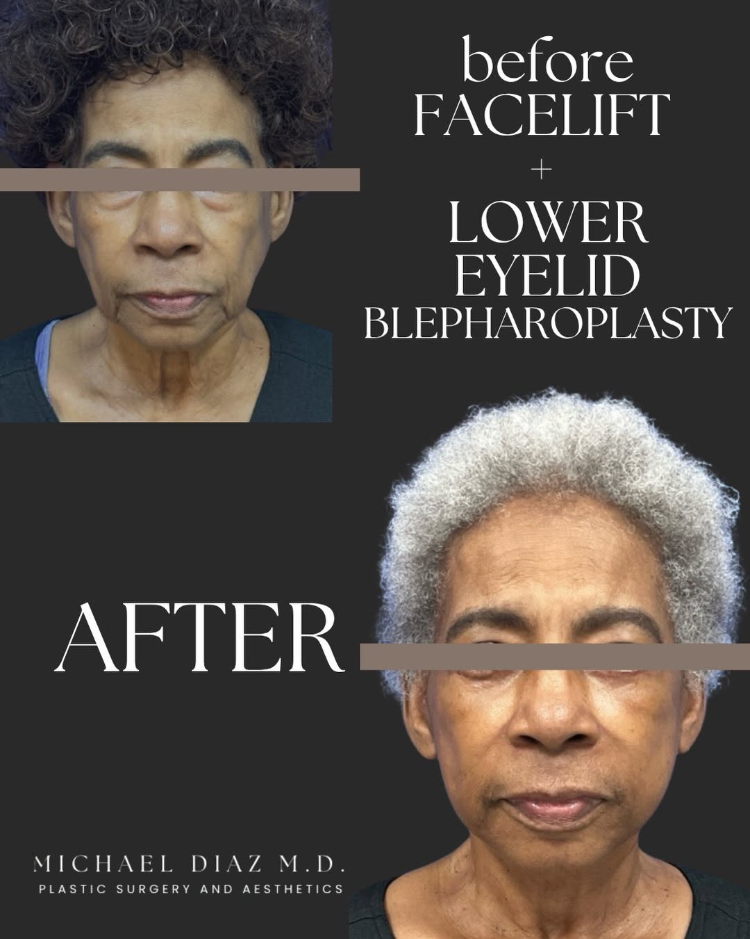 Instagram post by Dr. Michael Diaz: This patient looks 15 years younger 🤯 HOW?! 1) Loose Skin Removal to Lower Face and Neck 2) Volume Restoration to Central Face 3) Peri Orbi…