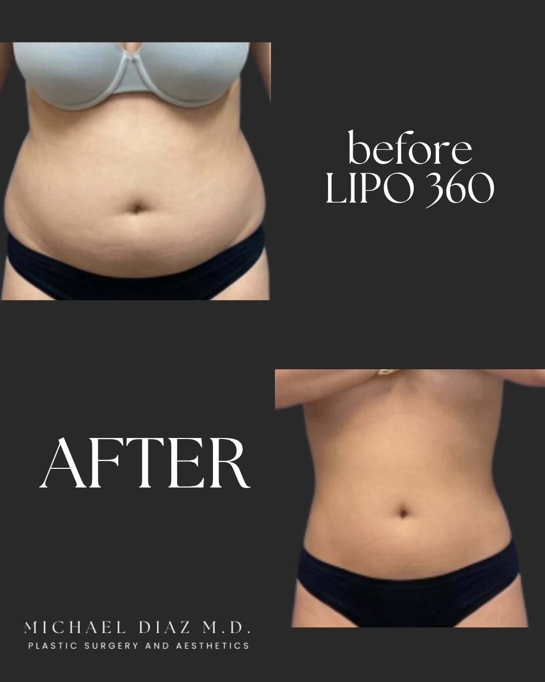 Instagram post by Dr. Michael Diaz: Q: What is Lipo 360? A: Liposuction to abdomen, back, and flanks 😇 Check out our amazing patient! We are so thrilled for them!! #lipo360 #m…