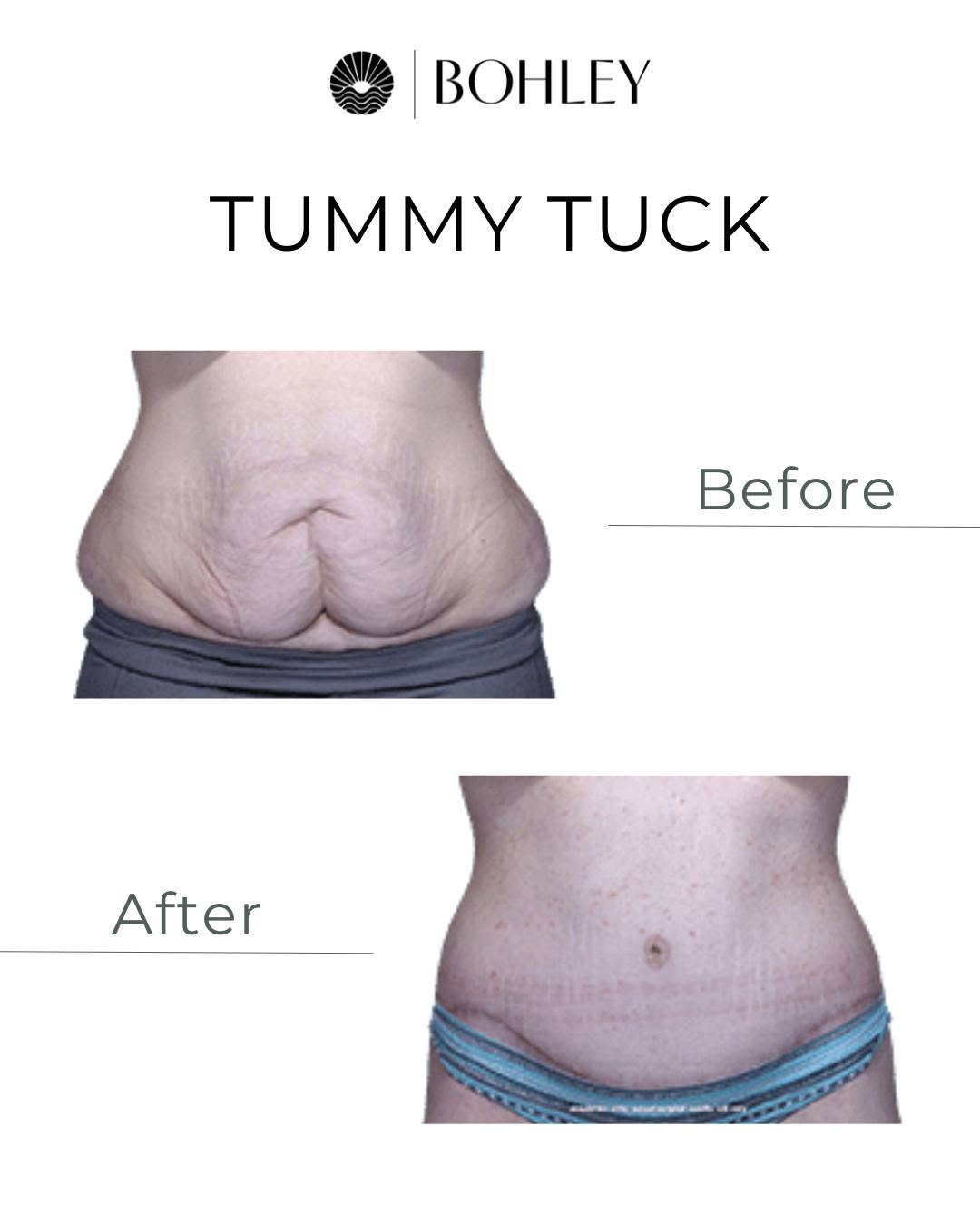 Instagram post by Dr. Michael F. Bohley: Like what you see? This is the power of a tummy tuck. It removes excess skin and fat while tightening muscles weakened by pregnancy, weight …