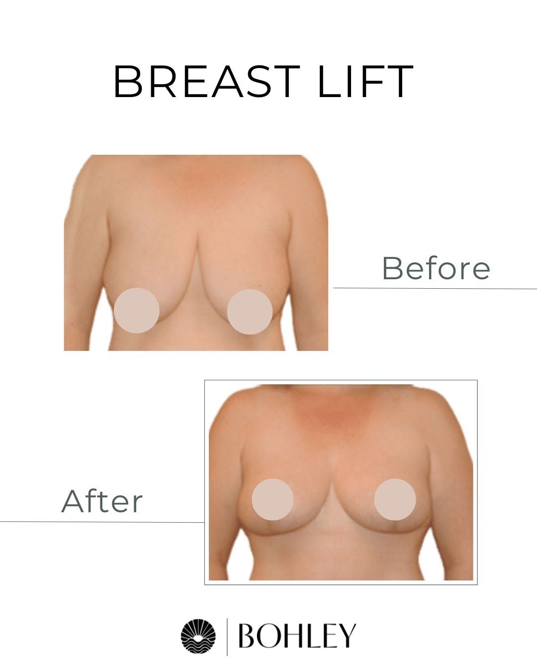 Instagram post by Dr. Michael F. Bohley: Before and after breast lift surgery with double board-certified Dr. Michael Bohley. A breast lift, or mastopexy, addresses sagging and repo…