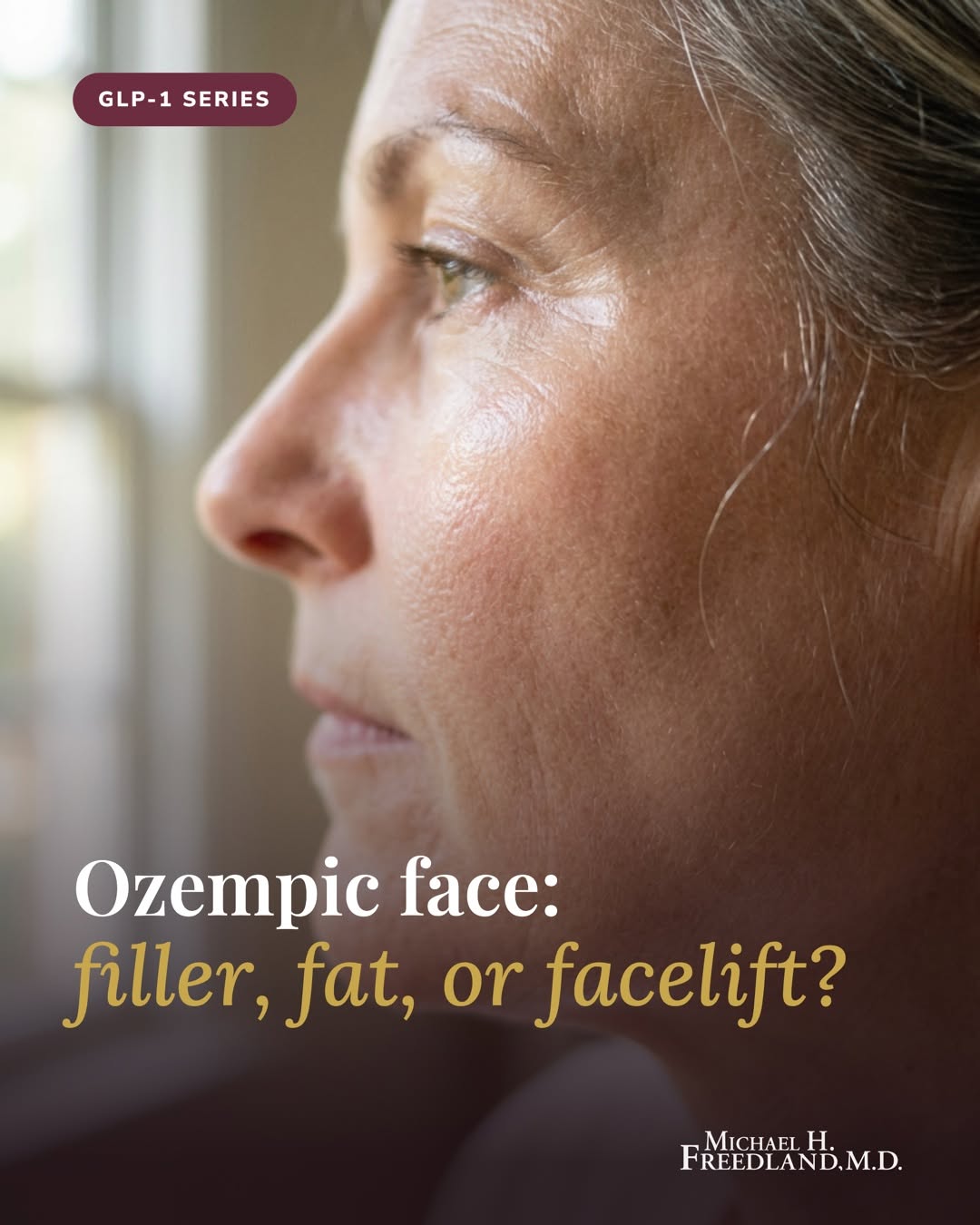 Instagram post by Dr. Michael Freedland: Rapid weight loss can age the face. Hollowing, loose skin, the look people call Ozempic face. There is no single fix. Filler, fat transfer, …