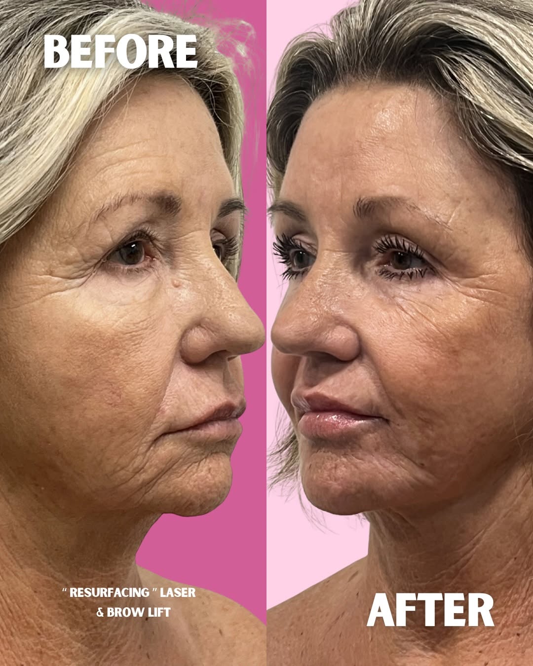 Instagram post by Dr. Michael J. Frederick: Up went the brows, off came the damage ✨ #browlift #resurfacinglaser #plasticsurgeon #oaklandparkfl #lespa