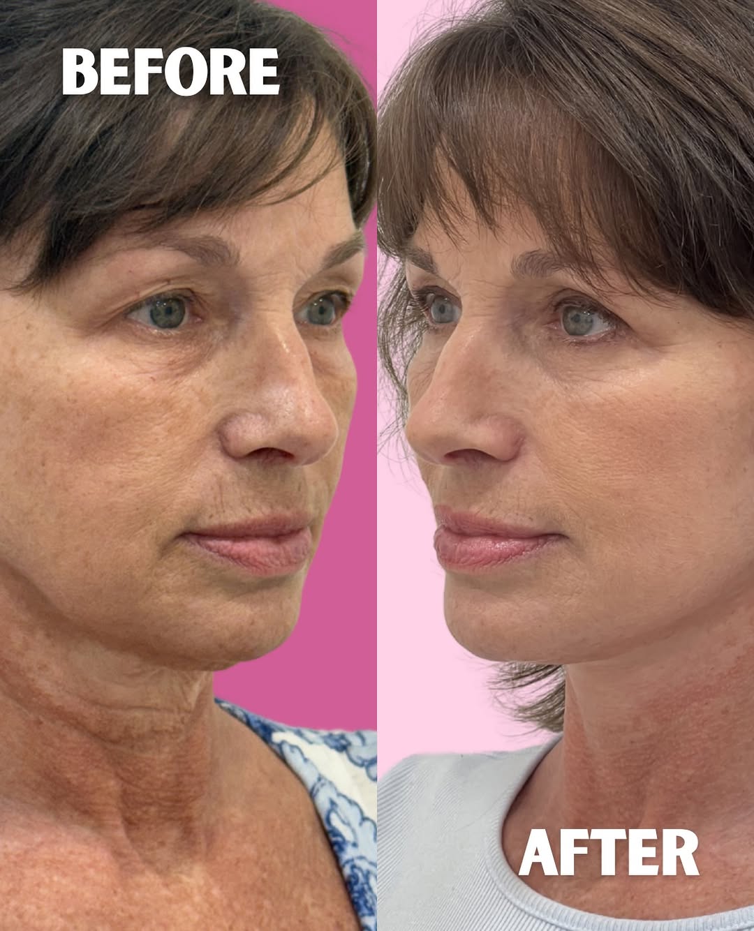 Instagram post by Dr. Michael J. Frederick: This is 58 — one month after a Weekend Lift+ and an upper blepharoplasty. 🔥 #weekendlift #facelift #blepharoplasty #necklift #lespaplastics…