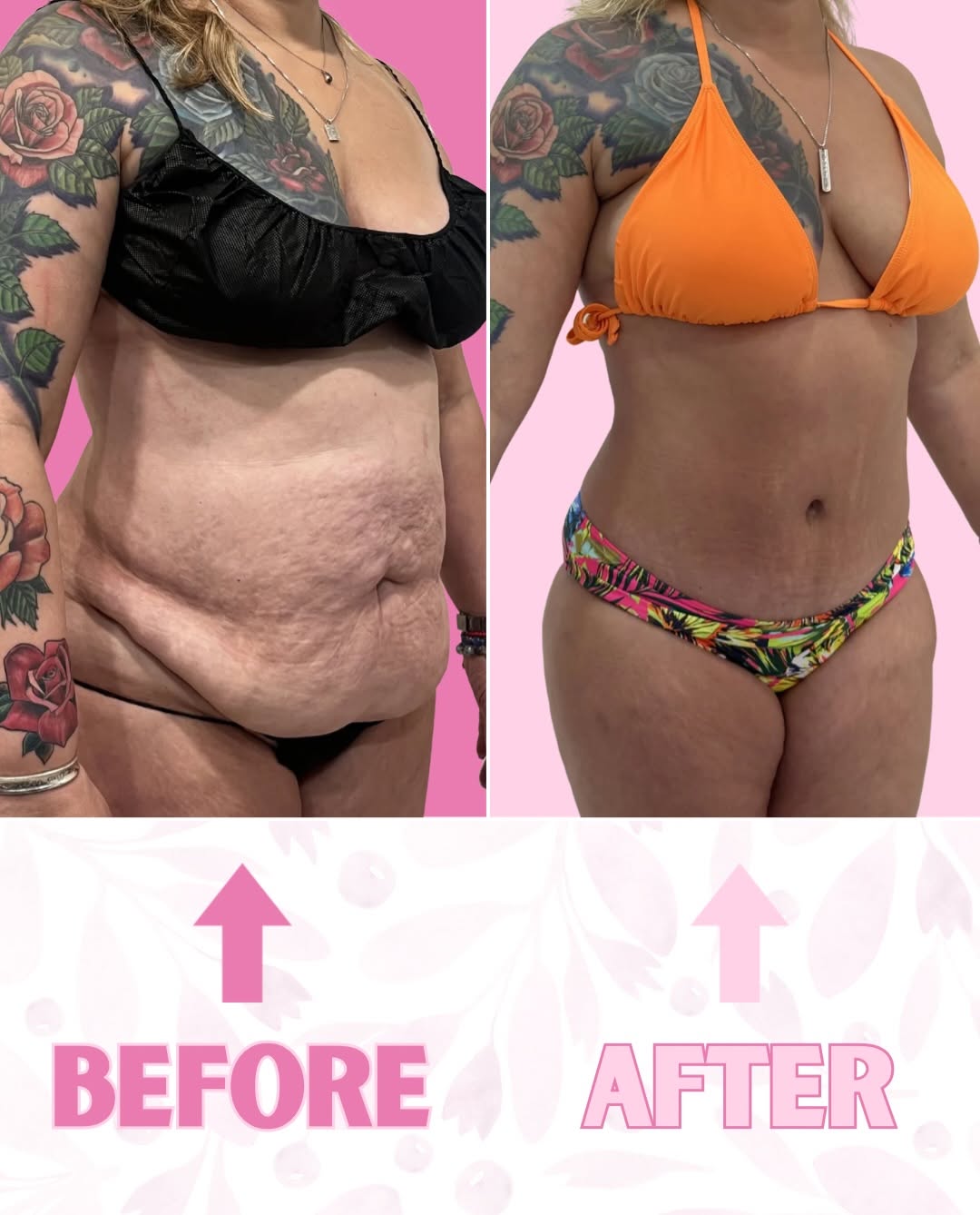 Instagram post by Dr. Michael J. Frederick: She couldn’t wait for a beach day to show this off 😍🔥 lipo 360 + extended tummy tuck #lipo360 #tummytuck #bodycontouring #plasticsurgery #…