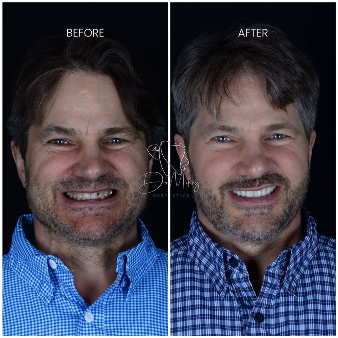 Comparative image of the same person before and after a full mouth reconstruction.

In the before image the gentleman looks older than in the after image.

In the after image the smile is more beautif