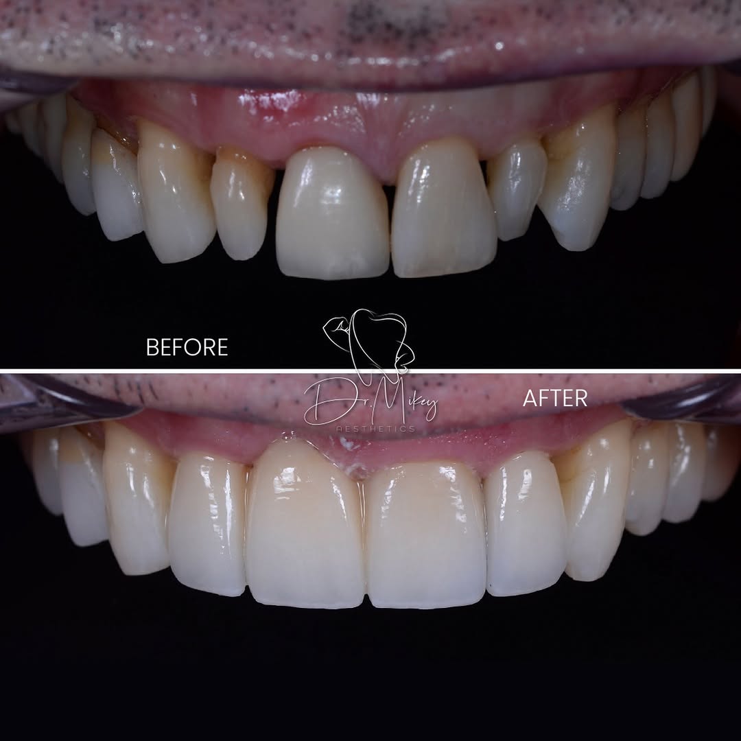 Before and after of a four front teeth smile makeover with a dental bridge and single crown restoring tooth #8.