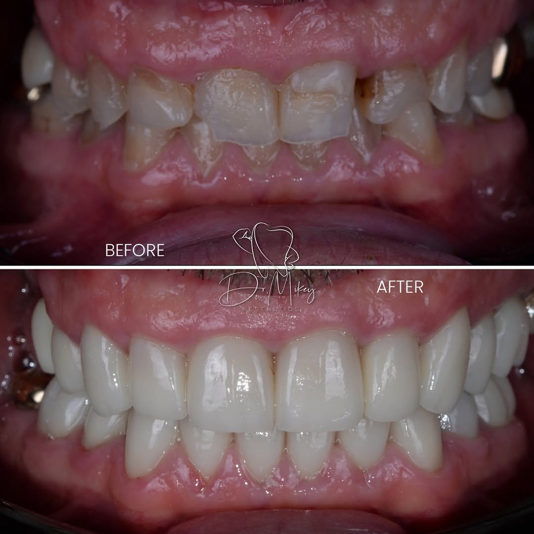 Before-and-after of a full mouth reconstruction showing the patient’s restored smile with natural-looking teeth.