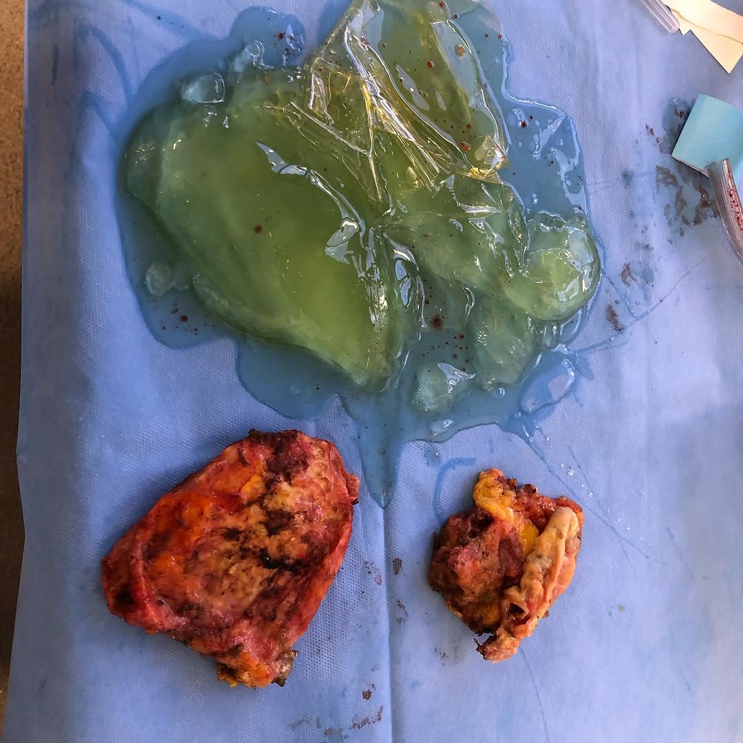 Instagram post by Dr. Michael K. Kim: 40 year old implants and capsule #breastaugmentation #breastimplants