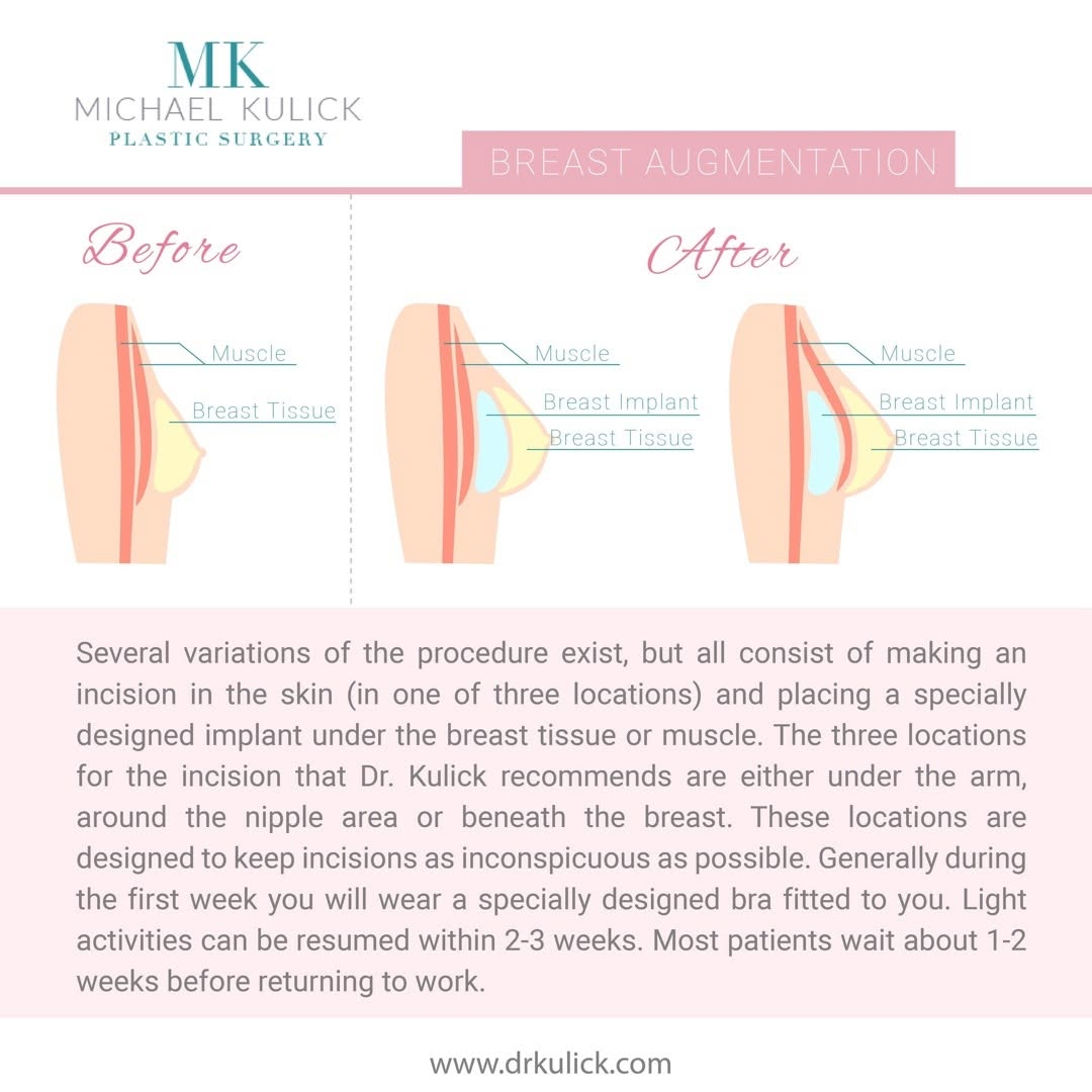 Instagram post by Dr. Michael Kulick: Breast augmentation by Dr. Michael Kulick, MD ⠀ Board Certified Plastic Surgeon ⠀ Http://drkulick.com⠀ Info on my techniques + reviews searc…
