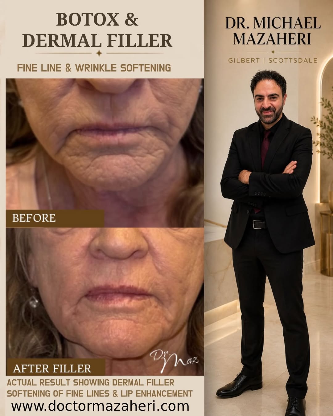 Instagram post by Dr. Michael Mazaheri, DDS: Dr. Michael Mazaheri using Dermal Fillers to soften fine lines around the mouth and the Marionette lines along with some mild lip filler enh…