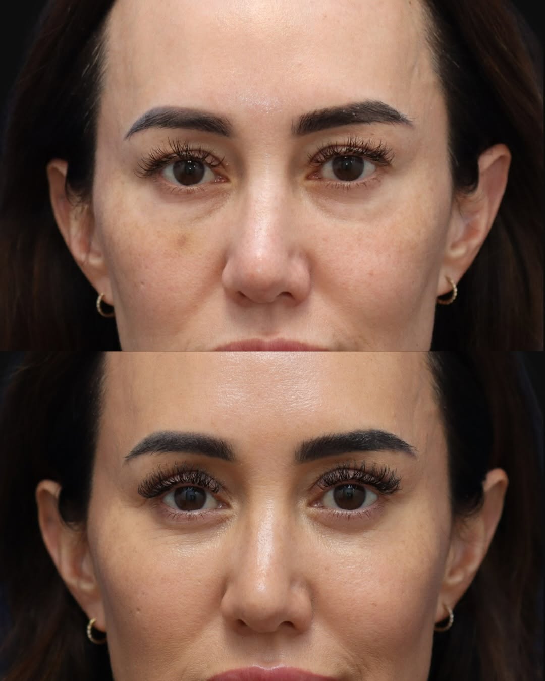 Instagram post by Dr. Michael McCracken: She’s an injector. She knows filler better than almost anyone. And she knew filler wasn’t the answer for her under-eyes. Fluid doesn’t fix f…