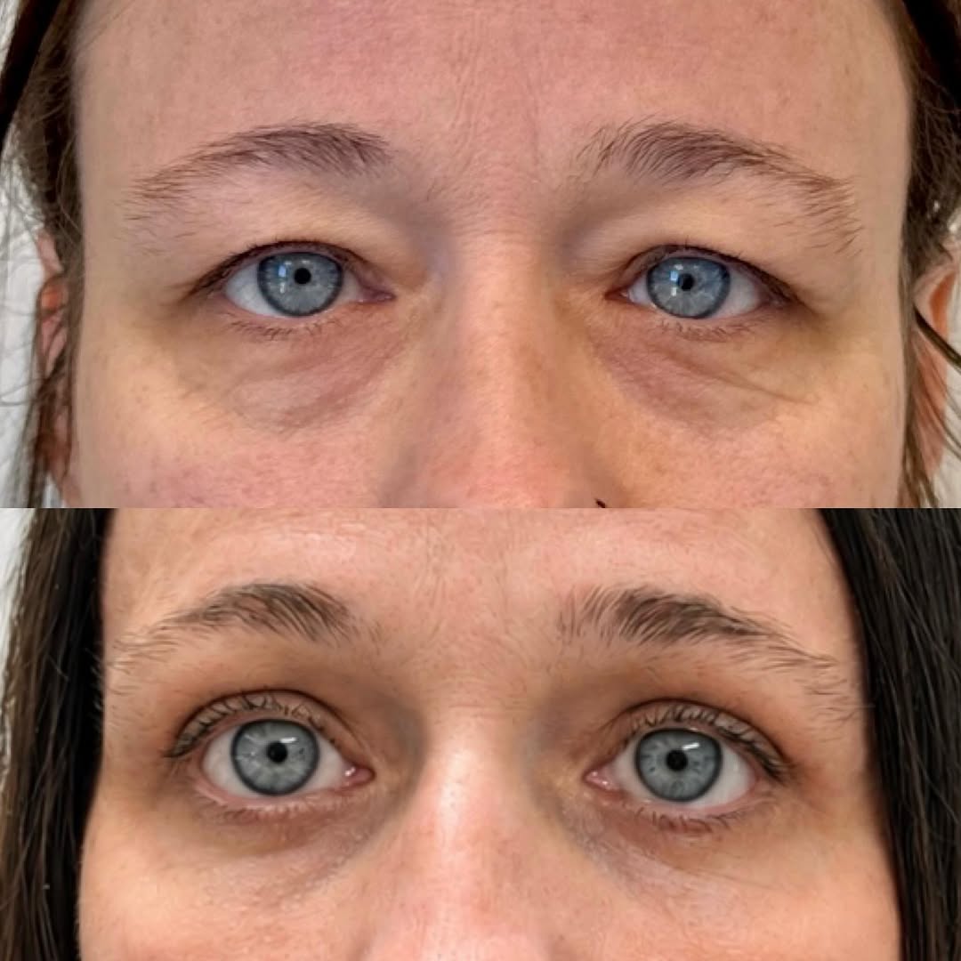 Instagram post by Dr. Michael Neimkin: Refreshed 👀s after an upper and lower blepharoplasty for this beautiful 46 YO female 👇👇 . This beautiful 46 YO female sought a refresh of…