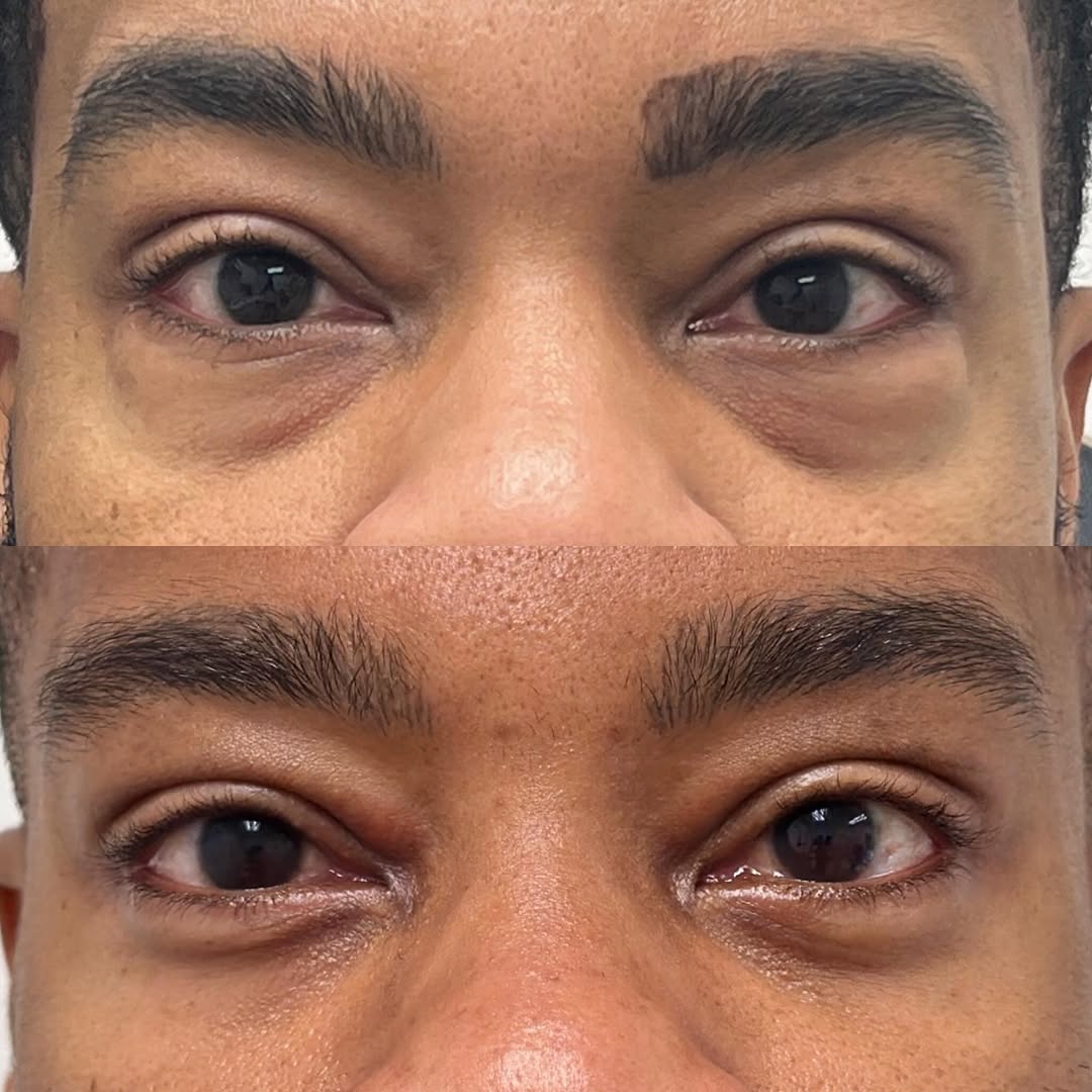 Instagram post by Dr. Michael Neimkin: Refreshed 👀s after a lower blepharoplasty for this handsome 40 YO male 👇👇 . This 40 YO male sought a refresh his lower eyelids. He underw…