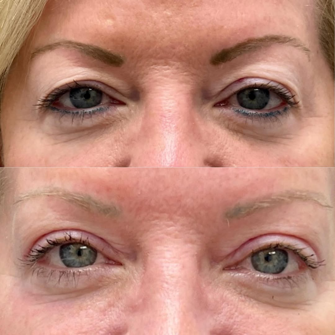 Instagram post by Dr. Michael Neimkin: Before and after an upper blepharoplasty for these beautiful 51 YO 👀s 👇👇 . An upper eyelid blepharoplasty is arguably the most powerful p…