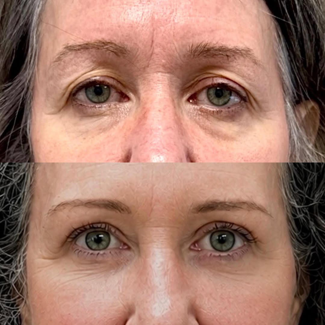 Instagram post by Dr. Michael Neimkin: Refreshed 👀s after a temporal browlift, upper blepharoplasty and lower blepharoplasty with SOOF lift for this beautiful 62 YO. 👇👇 . Our t…