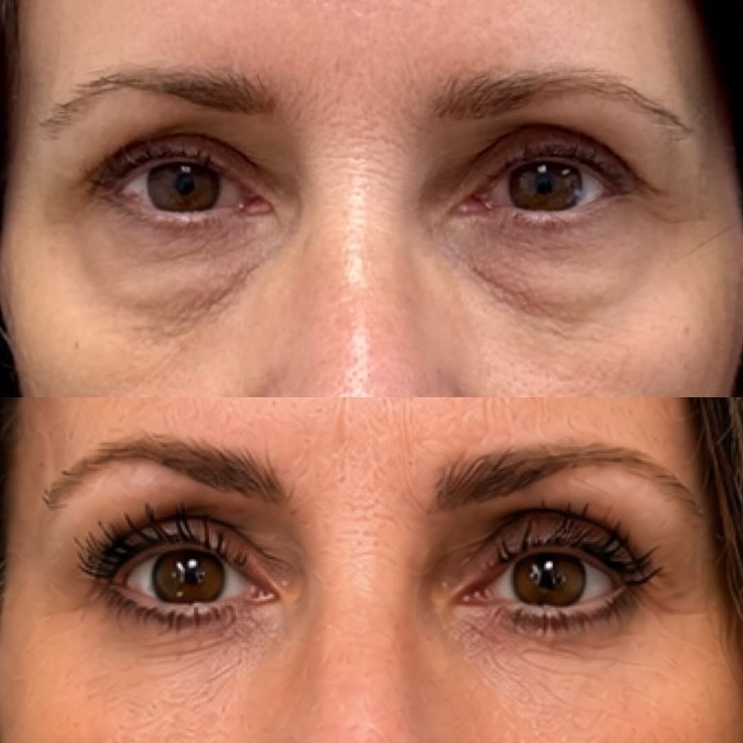 Instagram post by Dr. Michael Neimkin: Refreshed 👀s after a temporal browlif and lower blepharoplasty with SOOF lift for this beautiful 55 YO👇👇 . This beautiful 55 YO female so…