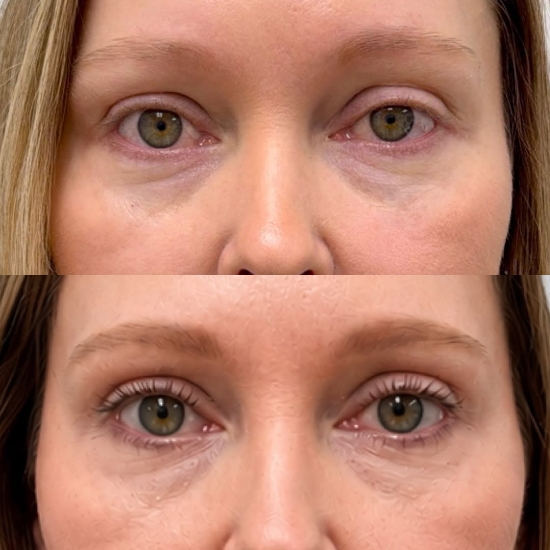 Instagram post by Dr. Michael Neimkin: Refreshed 👀s after a left ptosis repair and upper blepharoplasty for this beautiful 48 YO female👇 . These beautiful 👀s had muscle weaknes…