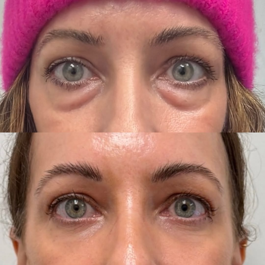 Instagram post by Dr. Michael Neimkin: Refreshed 👀s after a lower blepharoplasty for this beautiful 47 YO female 👇👇 . This beautiful 47 YO female sought to eliminate the puffin…