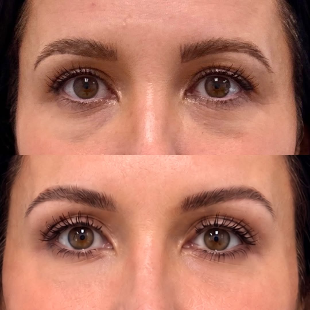 Instagram post by Dr. Michael Neimkin: Refreshed 👀s after a temporal browlift and lower blepharoplasty with full face laser skin resurfacing for this beautiful 48 YO female