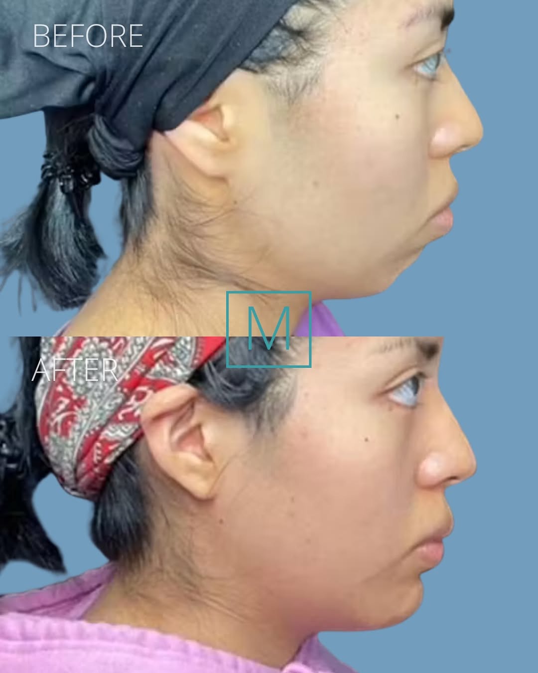 Instagram post by Dr. Michael P. Morrissette, DDS: Define your profile, one angle at a time. 🤩 Our patient underwent chin surgery (genioplasty) to enhance her jawline and facial structure b…