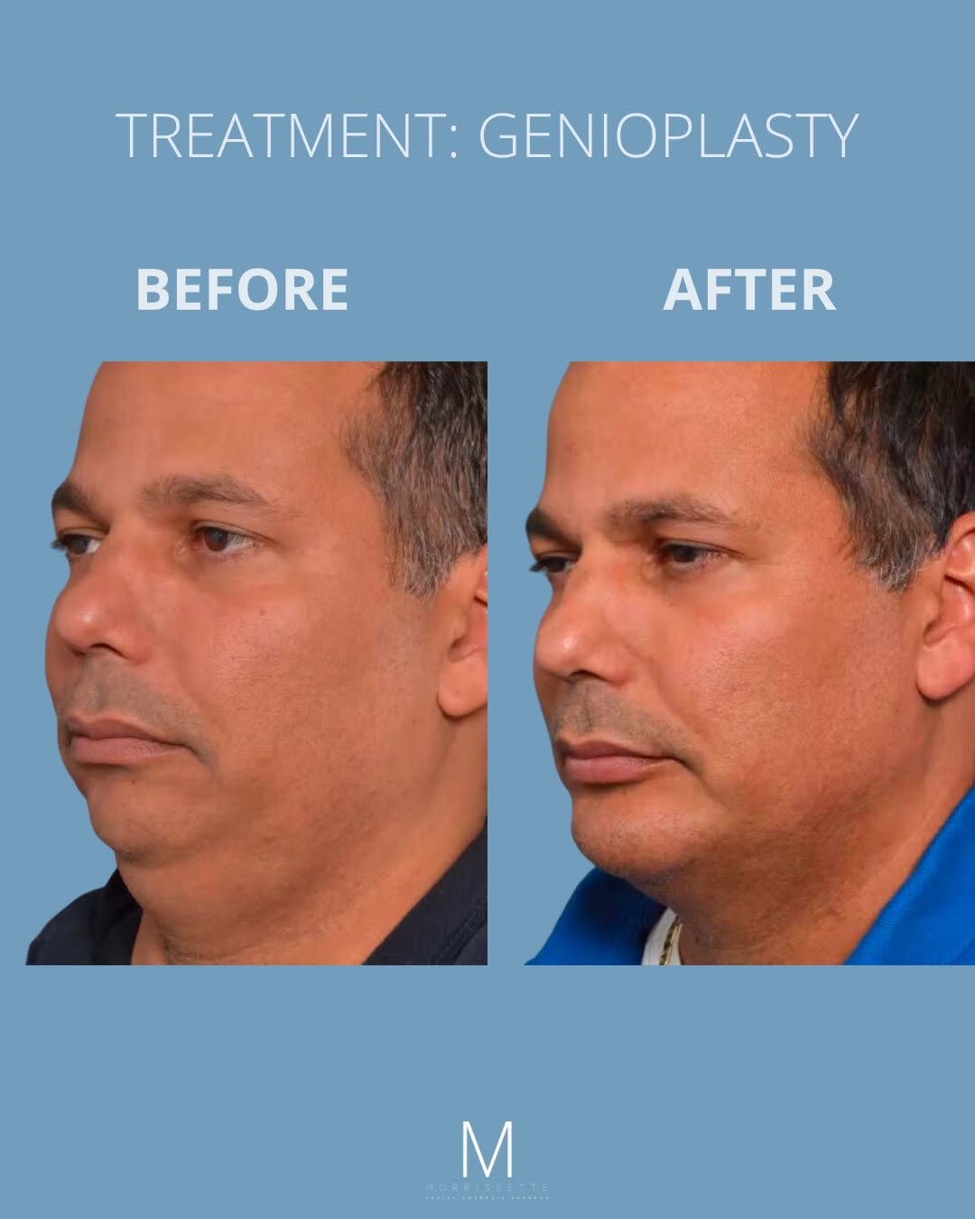 Instagram post by Dr. Michael P. Morrissette, DDS: Refined from every angle. ✨ This patient chose genioplasty, also known as chin enhancement surgery, to improve facial balance and definition…