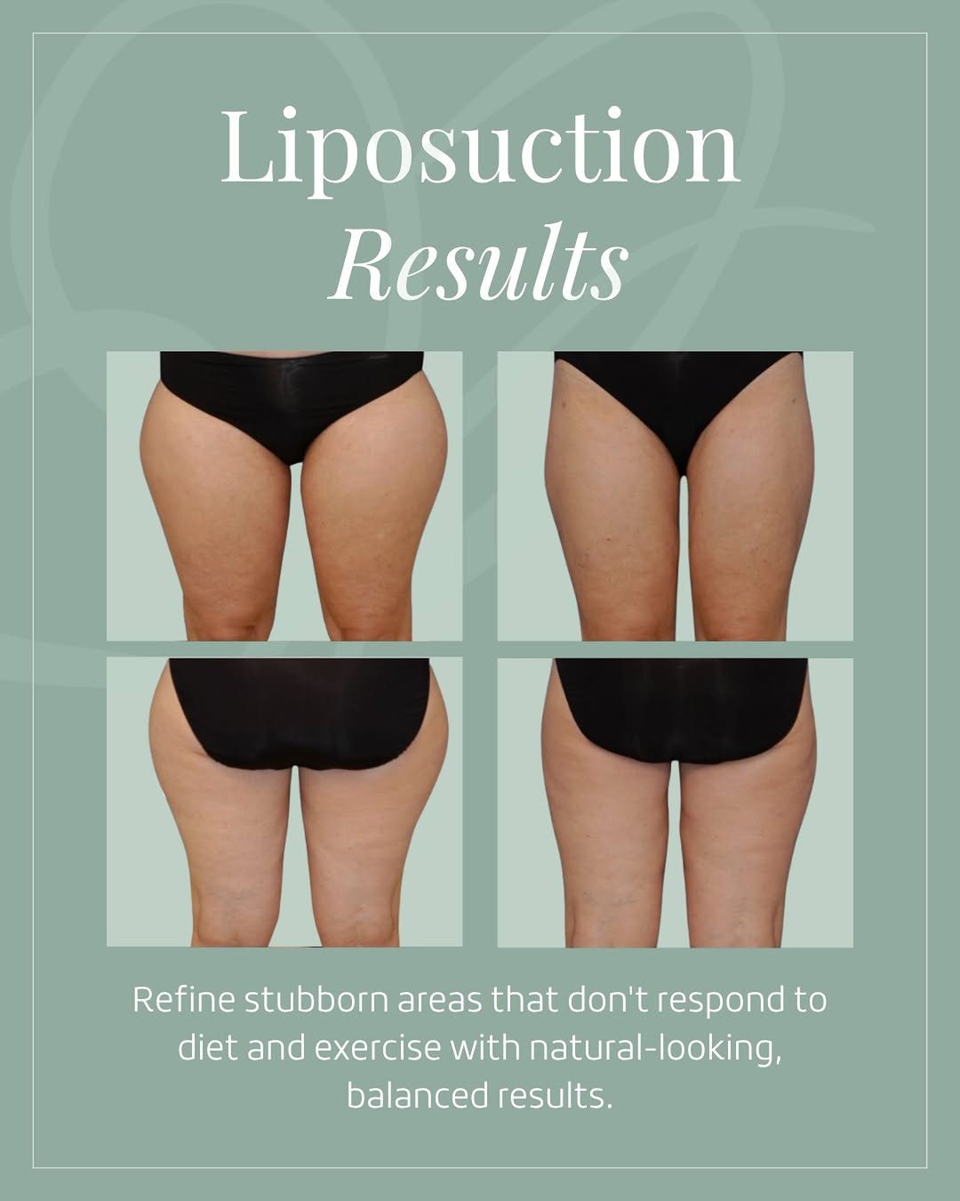 Instagram post by Dr. Michael Philbin: At 63, this patient wanted to create smoother, more balanced contours through her legs. Dr. Kobenia performed liposuction of the inner and o…