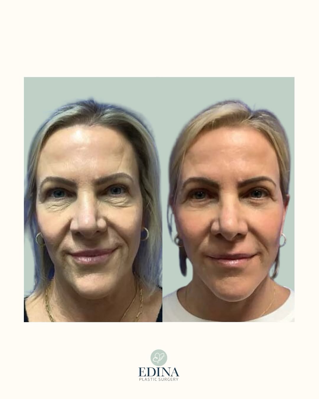 Instagram post by Dr. Michael Philbin: The eye area is often one of the first places we notice aging, but it’s rarely the only thing contributing to an older or more tired appeara…