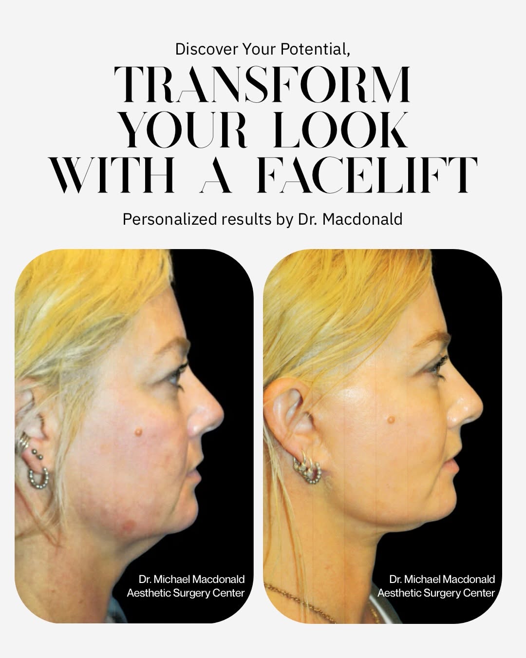 Instagram post by Dr. Michael R. Macdonald: ✨ Refine what bothers you, preserve what doesn’t. ✨ Step inside our San Francisco studio and imagine the possibilities. From rhinoplasty and…