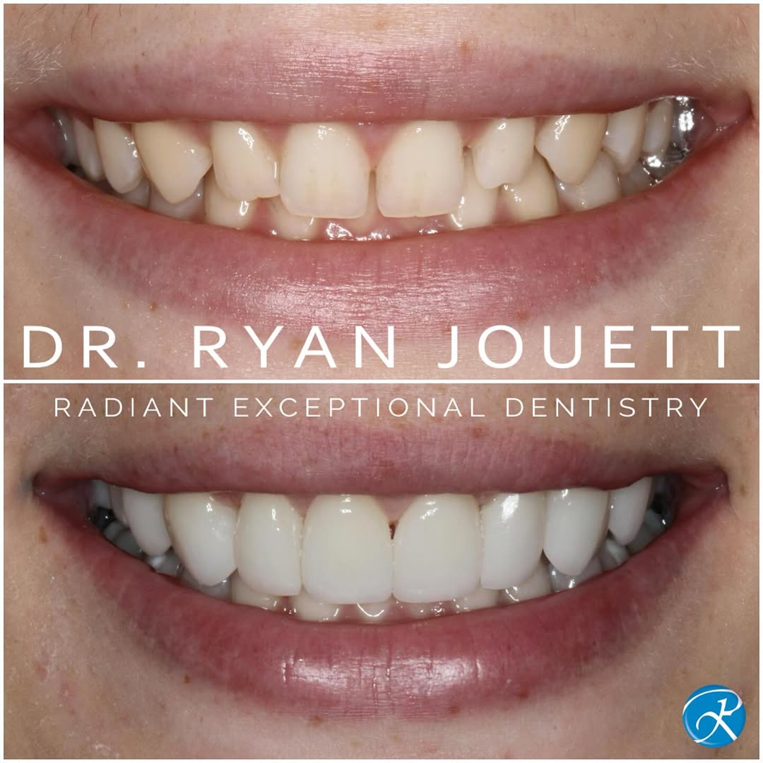 Instagram post by Dr. Michael Reece: We used 7 porcelain Veneers in this case to get the look she was going for. Smiling with confidence!!!! Do you ever hide your mouth when you…