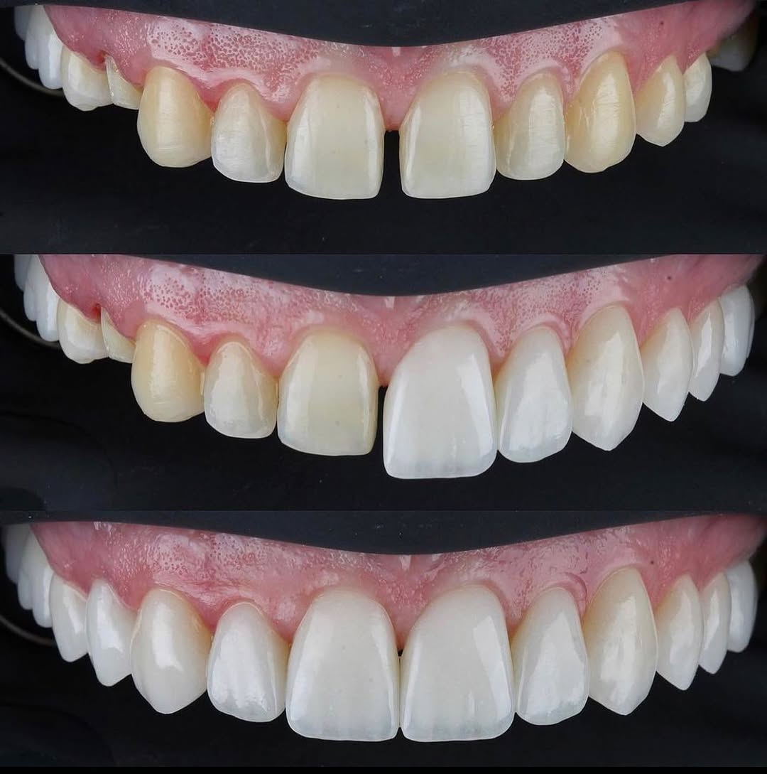 Instagram post by Dr. Michael S. Affleck, DDS: Veneers. Porcelain veneers give us the ability to drastically change and improve your smile with with minimal discomfort and time. We are ab…