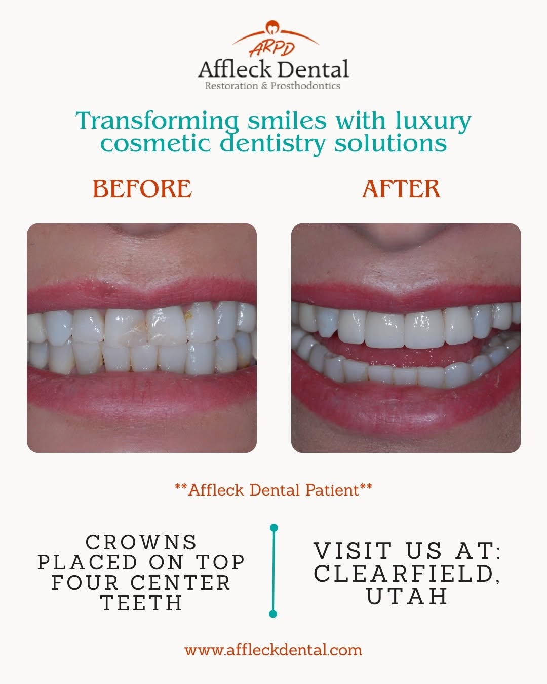 Instagram post by Dr. Michael S. Affleck, DDS: From worn to WOW ✨ Custom crowns on the four center teeth created this seamless, natural-looking transformation. Your smile deserves expert …