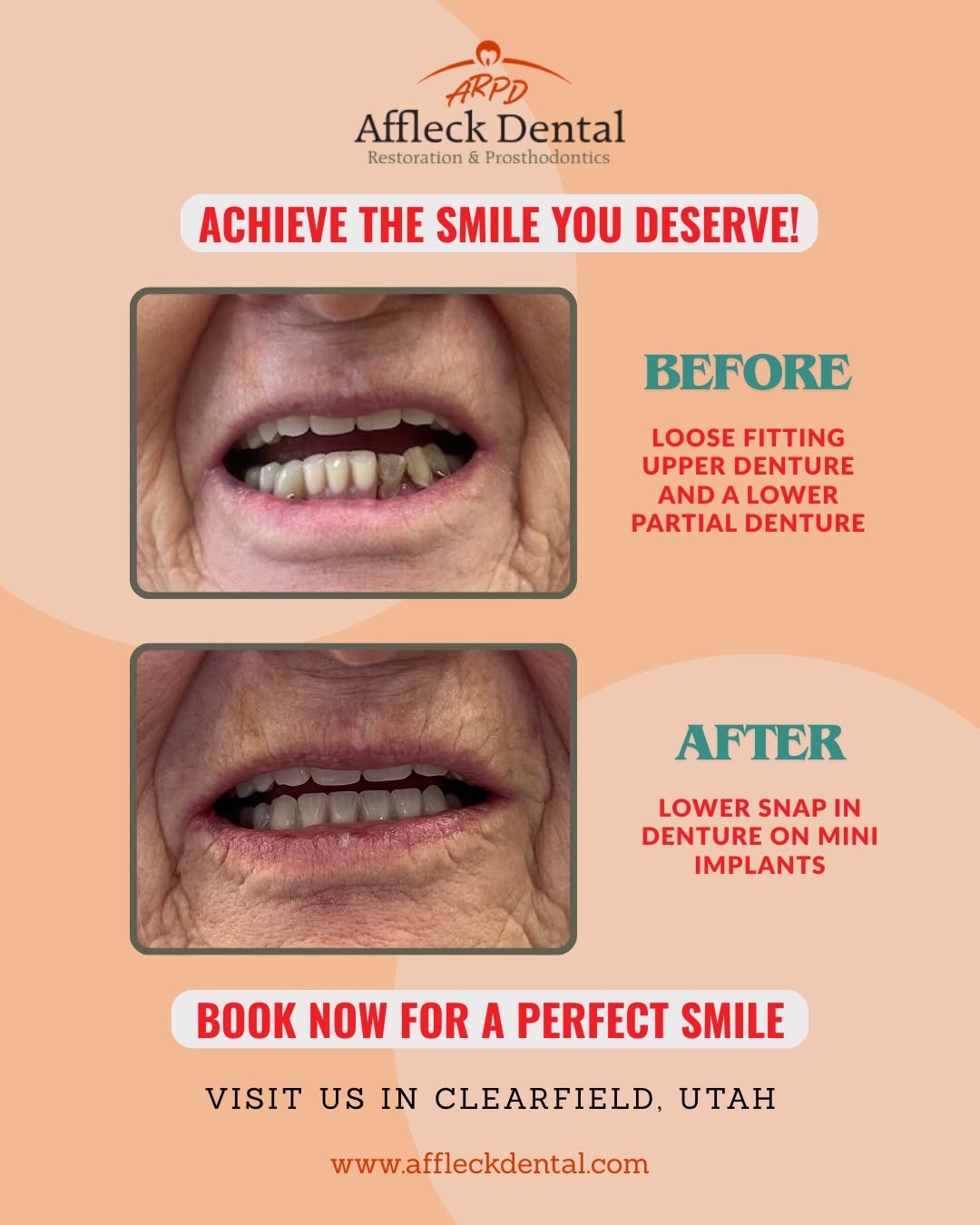 Instagram post by Dr. Michael S. Affleck, DDS: Your smile should feel as good as it looks ✨ If you’ve been dealing with loose dentures, you know how frustrating it can be—slipping, discom…