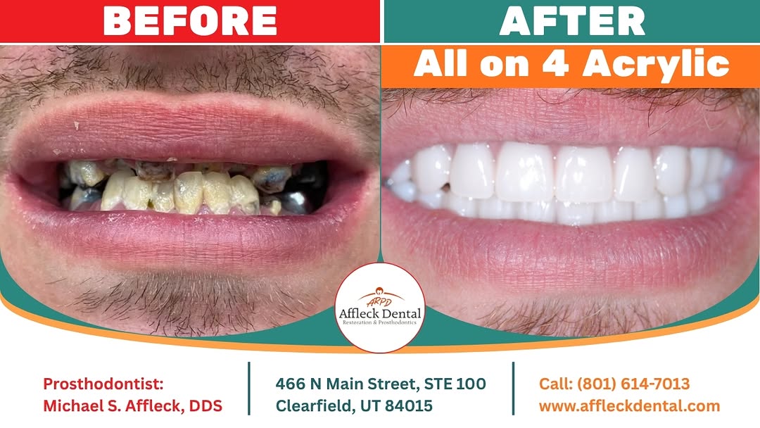 Instagram post by Dr. Michael S. Affleck, DDS: Eight implants. One day. A new chapter for Chris. 🦷 After severe tooth decay left Chris with very few teeth, he chose a permanent All-on-4 …
