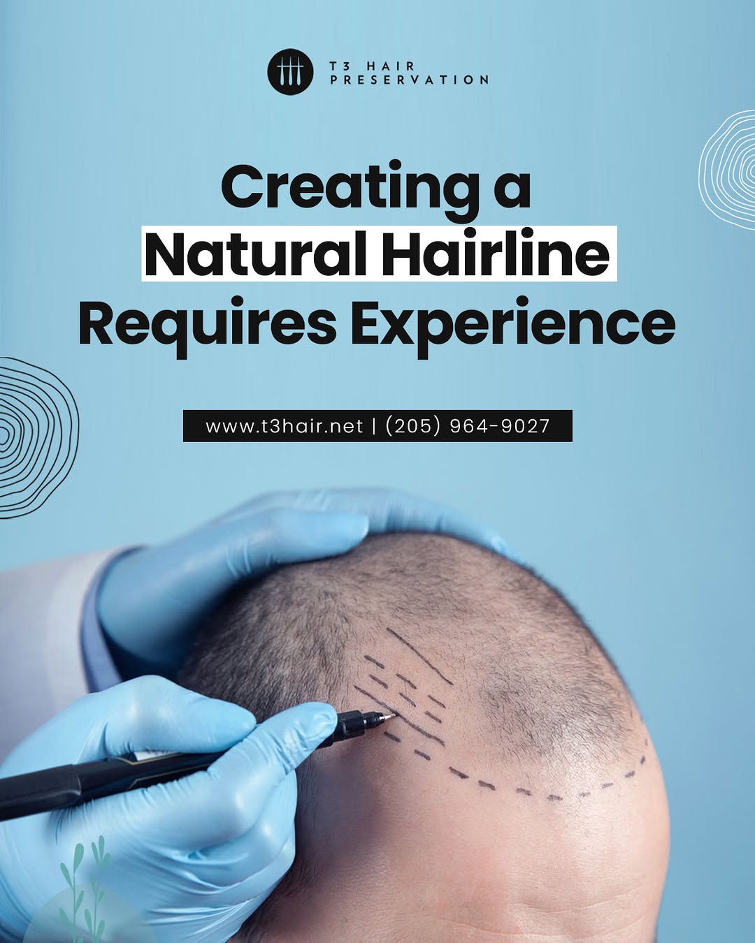 Instagram post by Dr. Michael S. Beckenstein: Designing a natural hairline requires precision, artistry, and medical expertise. At T3 Hair Preservation, Dr. Beckenstein carefully evaluat…
