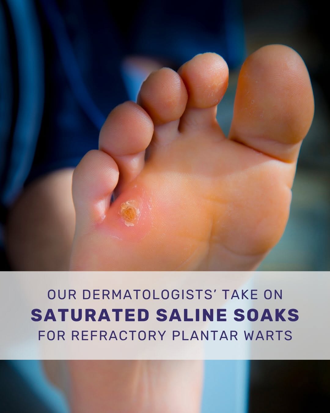 Instagram post by Dr. Michael S. Kaminer: Can soaking a plantar wart in saturated salt water really make it disappear? 🦶 A DIY simple saturated saline soaking treatment has been mak…