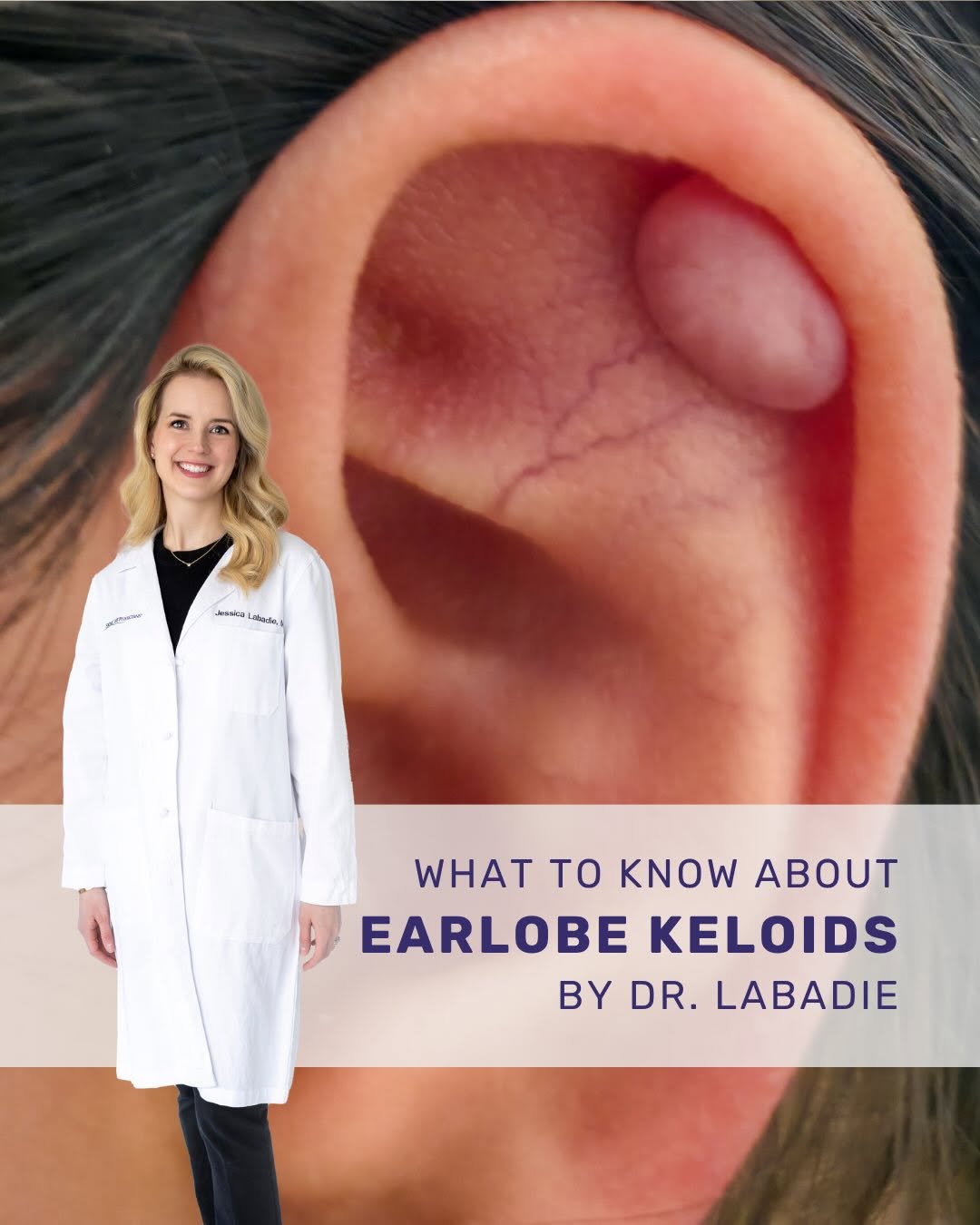 Instagram post by Dr. Michael S. Kaminer: Did you know ear piercing is the most common cause of earlobe keloids? These firm, rounded growths can continue to grow, won’t go away on th…
