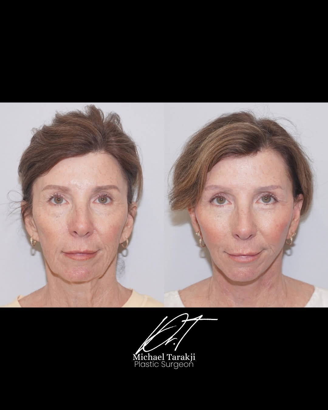 Instagram post by Dr. Michael S. Tarakji: Three months post-op and beautifully refreshed! 💖 This patient underwent a mid-face and neck lift, combine with an upper and lower blepharo…