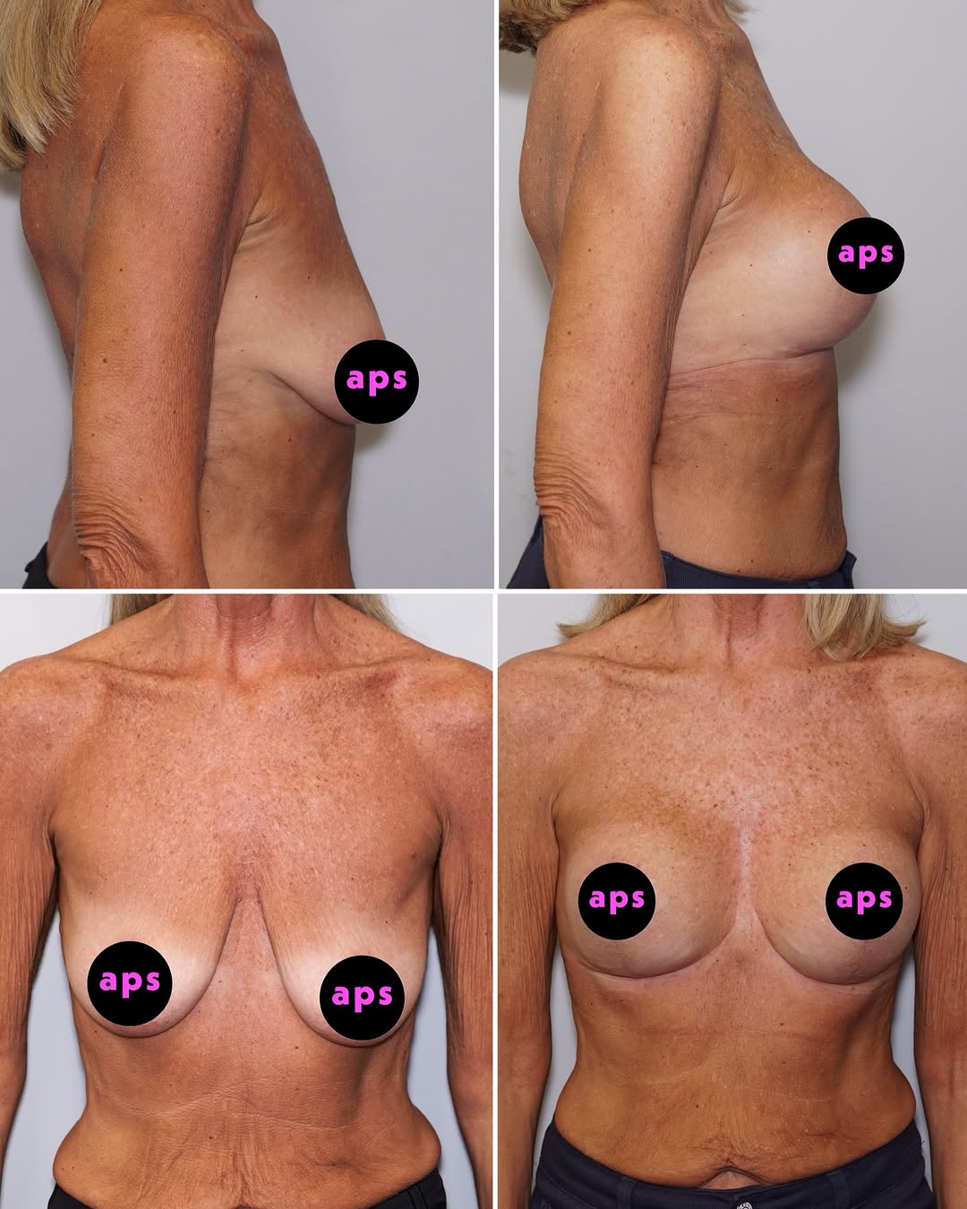 Instagram post by Dr. Michael S. Tarakji: A lift you can see, and a transformation that beautifully changed her proportions 👏 This patient went from a B cup to a full C with a breas…