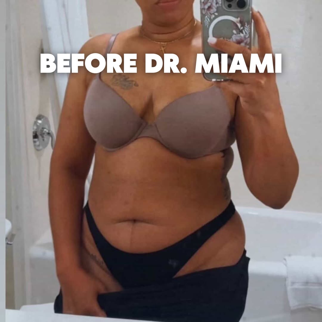 Instagram post by Dr. Michael Salzhauer: The Dr. Miami Effect ⚡️ This patient got a Mommy Makeover ✨ Breast Lift with Implants ✨ Tummy Tuck ✨ Lipo 360 BBL ✨ Arm Lip She’s 2 years po…