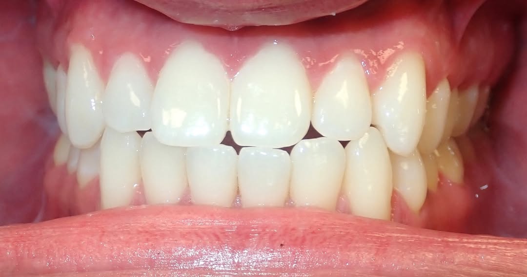 Instagram post by Dr. Michael Sheinis: ✨ Transformation Tuesday ✨ Swipe ➡️ to see this smile transformation! 😁🦷 Nothing better than watching confidence grow one smile at a time.…