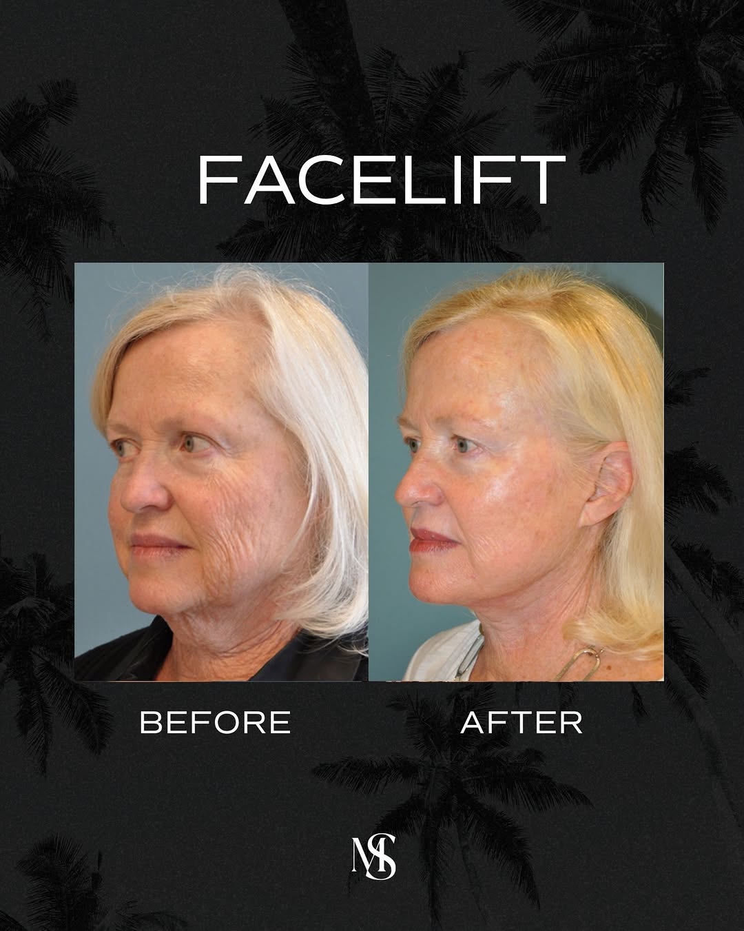 Instagram post by Dr. Michael Sundine: A facelift is never about changing the face. It’s about restoring definition, balance, and a more refreshed appearance while preserving the …
