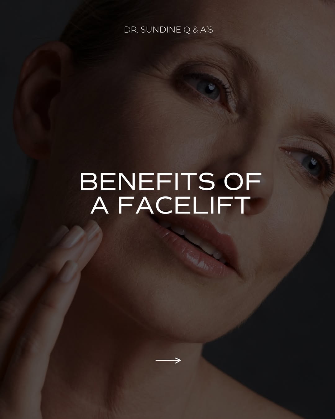 Instagram post by Dr. Michael Sundine: A facelift is about more than simply lifting the skin. It’s about restoring the natural contours and proportions of the face. For the right …