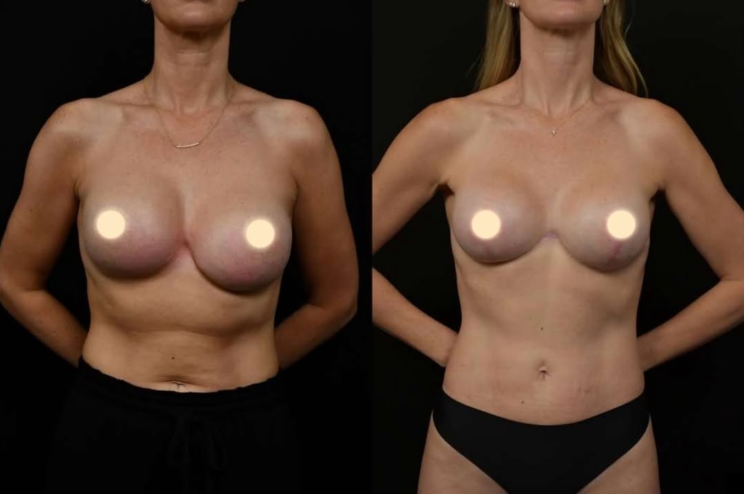 Instagram post by Dr. Michael T. Rossi: Subtle, balanced, and completely her ✨ This transformation combined 360° torso lipo, a reverse tummy tuck, and revision augmentation mastope…