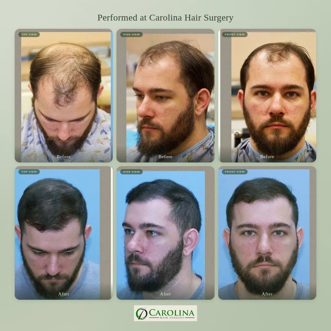 Instagram post by Dr. Michael Vories: Three angles. One transformation... ✂️ Crown, side profile and front. This patient walked in with significant thinning and walked out with a…