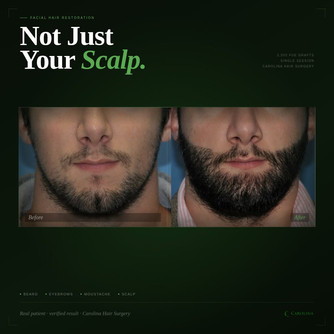 Instagram post by Dr. Michael Vories: Beard transplants are one of the most requested procedures at Carolina Hair Surgery & the results speak for themselves. 🙌 Whether you're lo…
