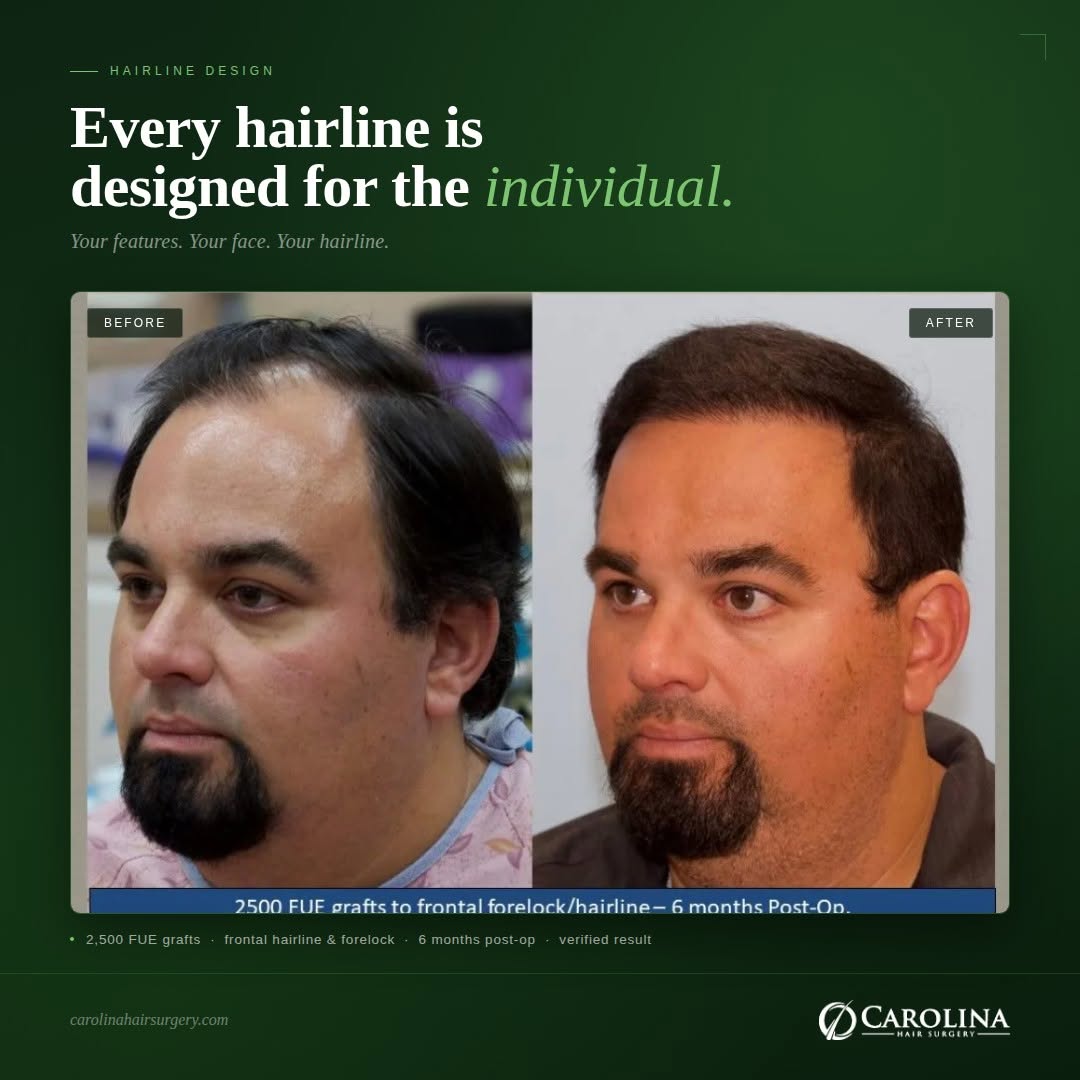 Instagram post by Dr. Michael Vories: A natural hairline is never copied from a template. It's designed. Before Dr. Vories places a single graft, your hairline is mapped around y…