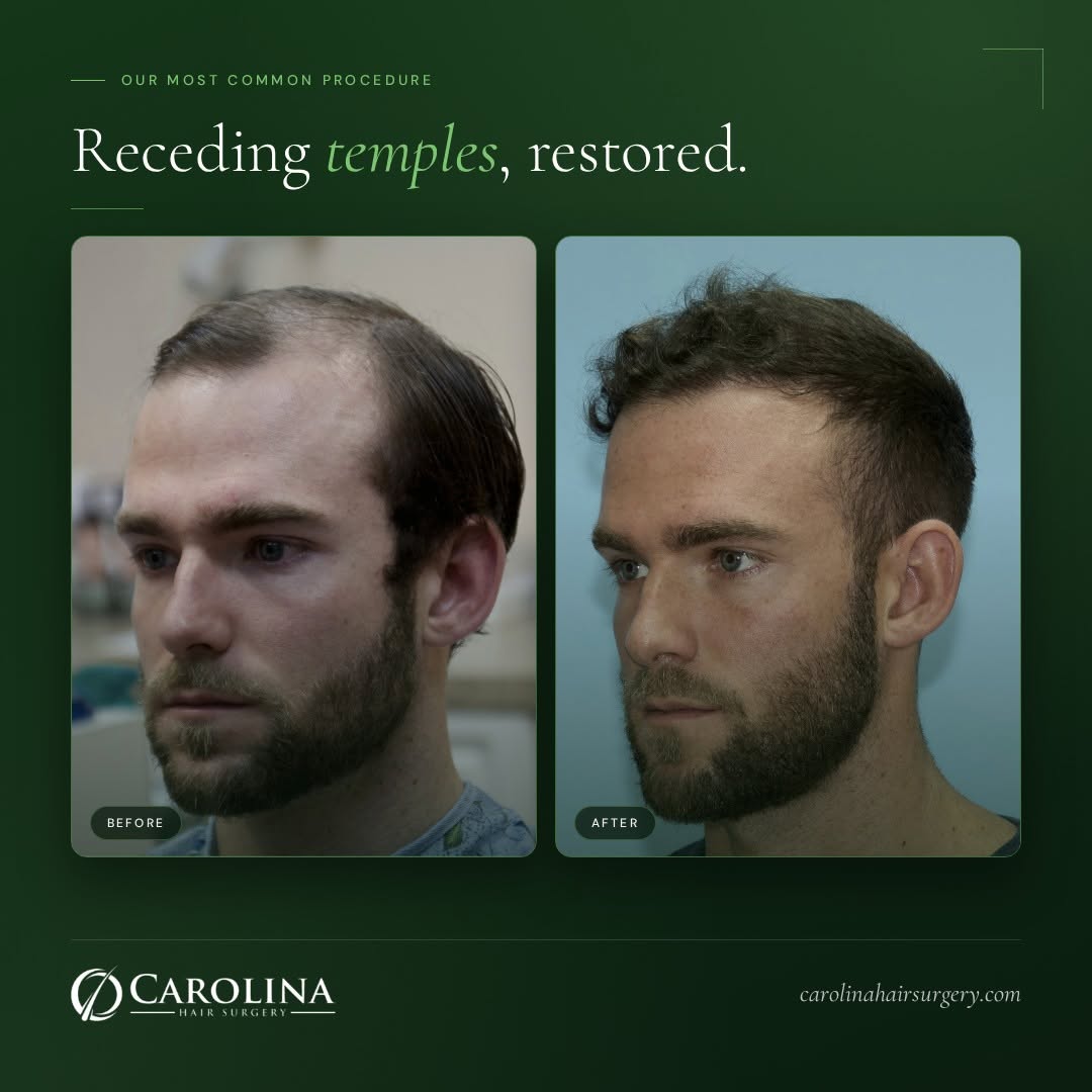 Instagram post by Dr. Michael Vories: Temples first. Almost always... Male pattern hair loss rarely starts at the crown. It starts at the corners, the hairline drifts back into a…