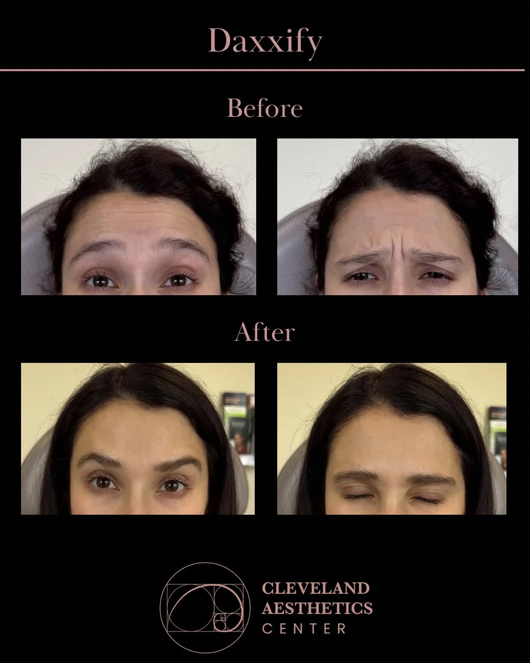 Instagram post by Dr. Michael Yerukhim: These are some before-and-afters from one of our favorite neurotoxins, Daxxify. ✨ Same expressions. Smoother, refreshed results. 💉💕 Ready …